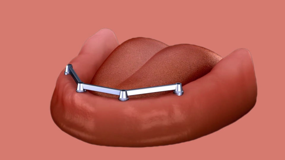 Metal Partial